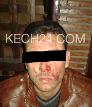 عاجل : اعتداء شنيع على سائق طاكسي من طرف دركيين بجيليز مراكش + صورة الضحية عاجل : اعتداء شنيع على سائق طاكسي من طرف دركيين بجيليز مراكش + صورة الضحية