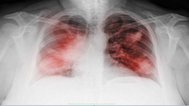 3 علامات تحذيرية غير معتادة قد تكشف الإصابة بسرطان الرئة